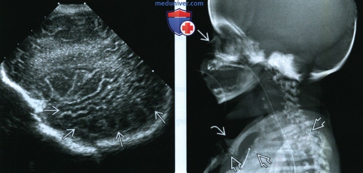 УЗИ, рентгенограмма при точечной хондродисплазии у плода
