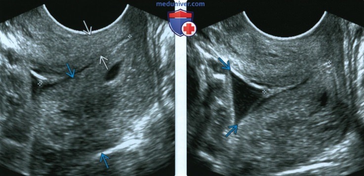 УЗИ при истмико-церивикальной недостаточности (ИЦН), укорочения шейки матки у беременной