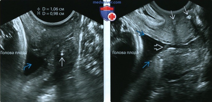 УЗИ при истмико-церивикальной недостаточности (ИЦН), укорочения шейки матки у беременной