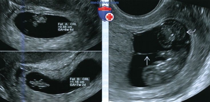 УЗИ при синдроме обратной артериальной перфузии при многоплодной беременности
