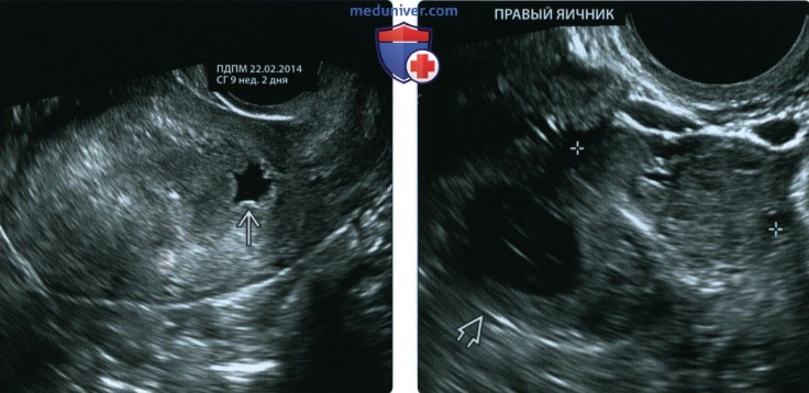 УЗИ при внематочной трубной беременности