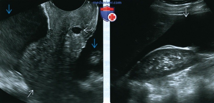УЗИ при внематочной трубной беременности