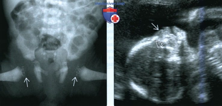 Лучевые признаки варфариновой (кумадиновой) эмбриопатии у плода