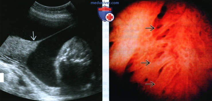 Лучевые признаки внутриматочных синехий у беременной