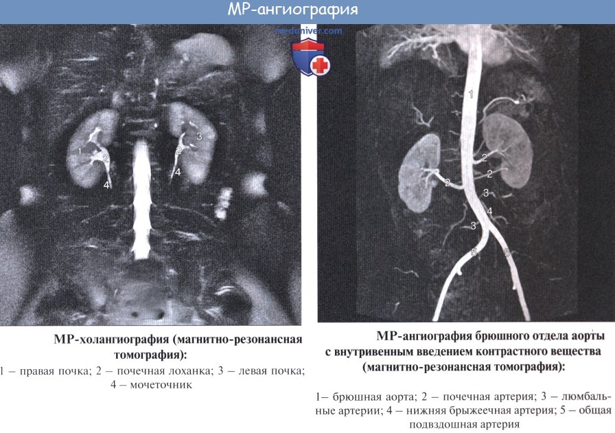 Анатомия: Лучевая анатомия почки (рентгенанатомия почки)