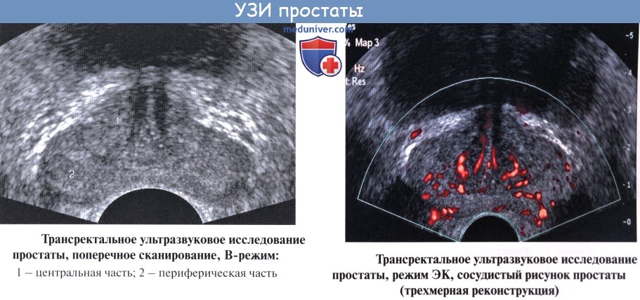 Головка простата. Трансректальное УЗИ предстательной железы. Гиперплазия предстательной железы УЗИ. Строение предстательной железы на УЗИ. Трузи предстательной железы анатомия.
