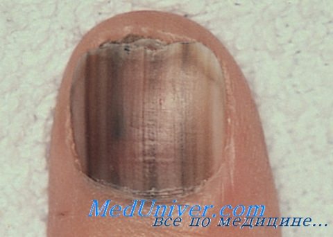 Меланома ногтя ноги дифференциальный thumbnail