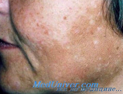 Гипертиреоз кожа на лице thumbnail