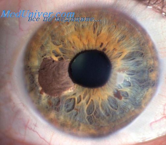 меланома глаза у больного