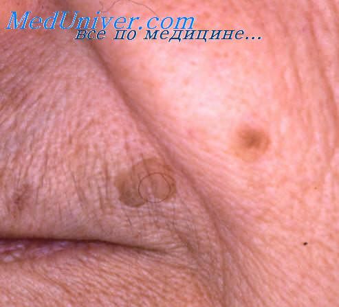злокачественные лимфомы кожи
