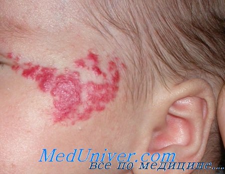 Атопический дерматит у ребенка: причины, симптомы и лечение | Дерматокосметика Eucerin