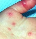 инфекционные поражения кожи