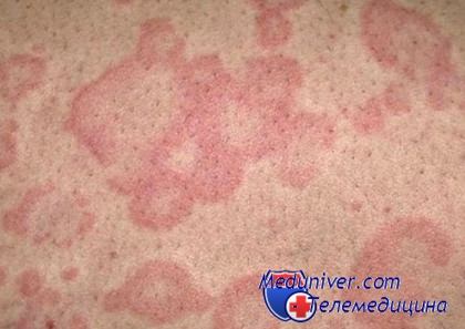 грибковые инфекции кожи
