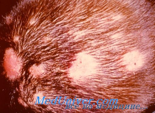 Дермофития волосистой части головы