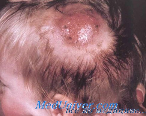 грибок волосистой части головы - дерматофития