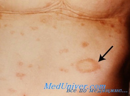грибок кожи - дерматофития кожи