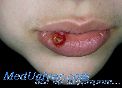 Пиогенная гранулема губы