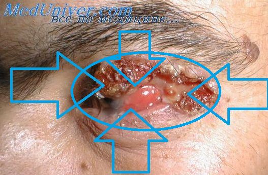 базальноклеточный рак глаза