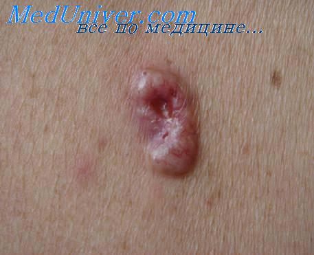 злокачественная лимфома кожи