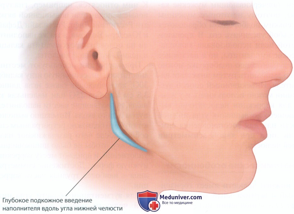 Методика инъекции филлеров (наполнителей) для аугментации угла нижней челюсти