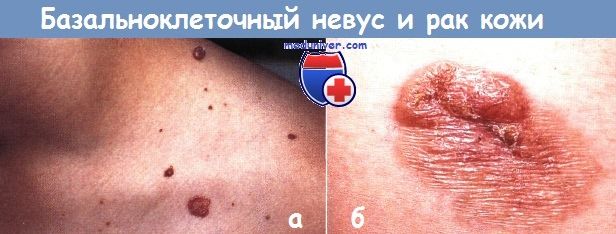 Базальноклеточный невус и рак кожи