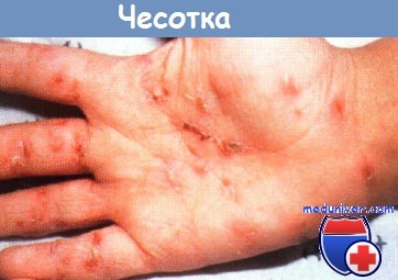 Дифференциальная диагностика дерматитов у детей thumbnail