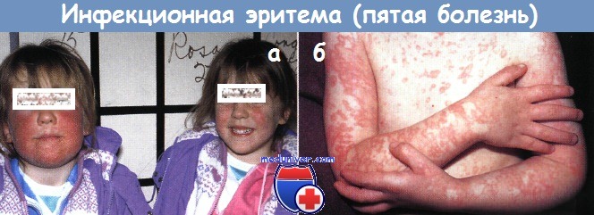 Инфекционная эритема - пятая болезнь у ребенка