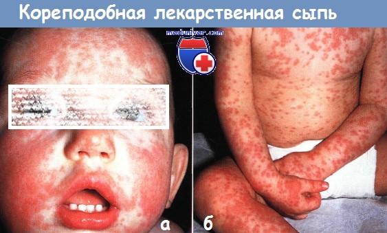 Кореподобная лекарственная сыпь у ребенка