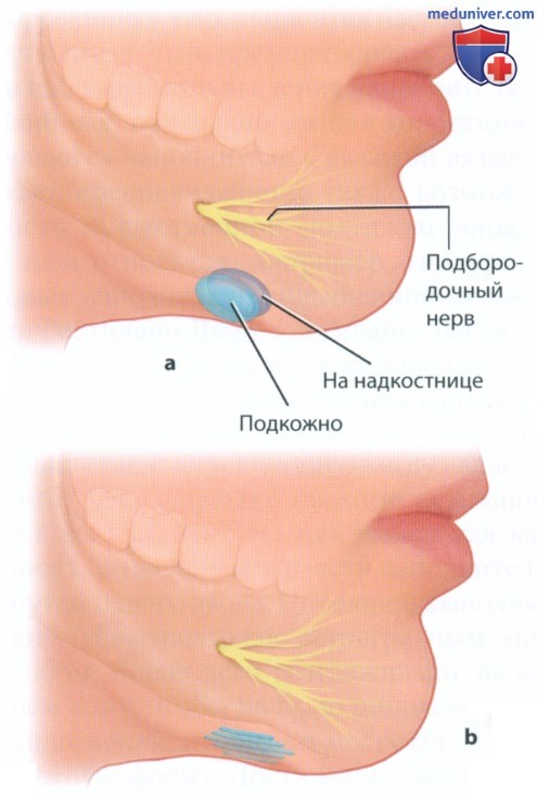 Методика инъекции филлеров (наполнителей) для коррекции контура нижней челюсти