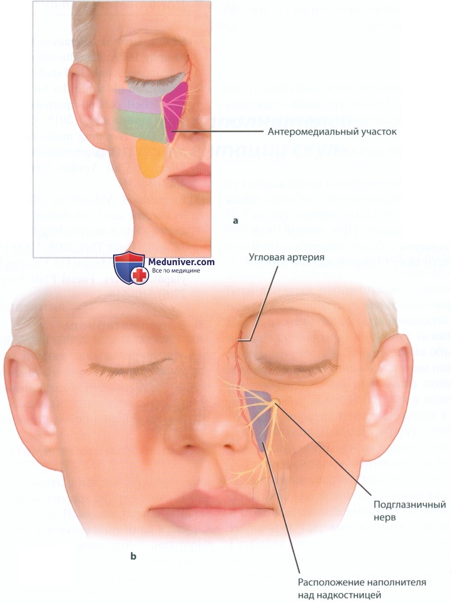 Методика инъекции филлеров (наполнителей) для коррекции медиальной впадины в центре лица