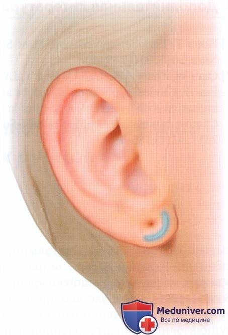 Методика инъекции филлеров (наполнителей) для коррекции мочки уха