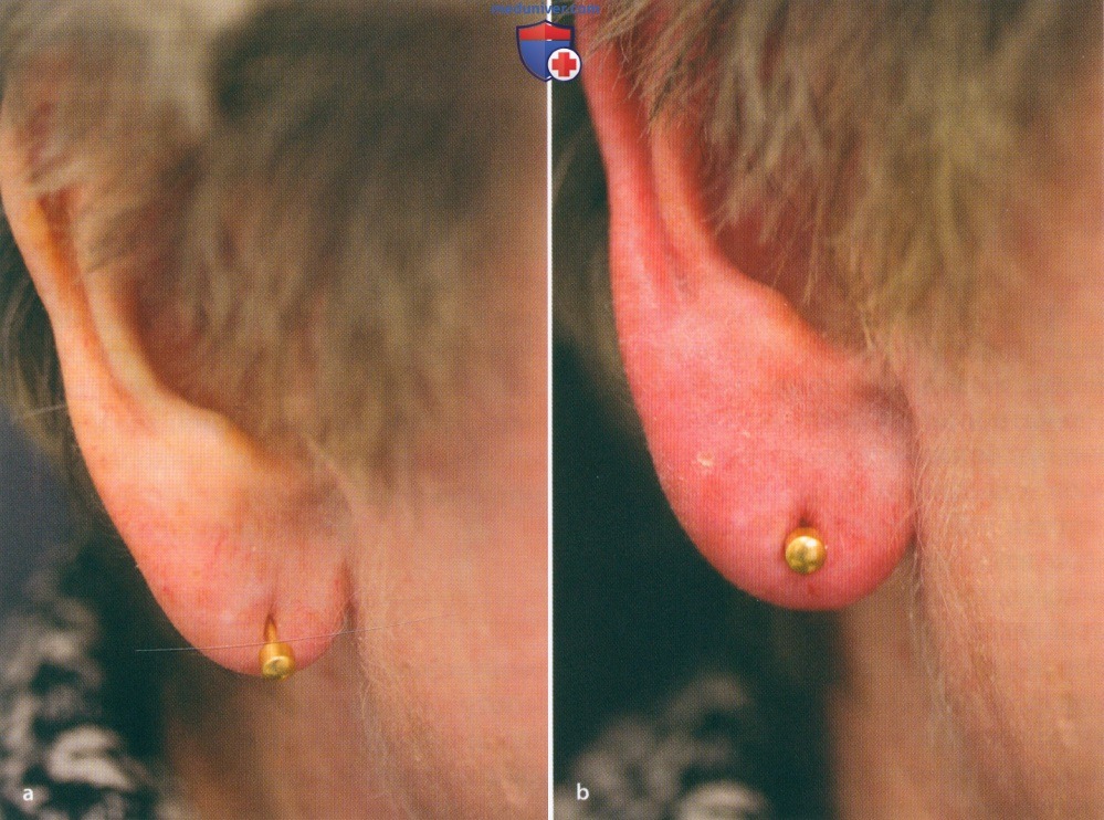 Методика инъекции филлеров (наполнителей) для коррекции мочки уха