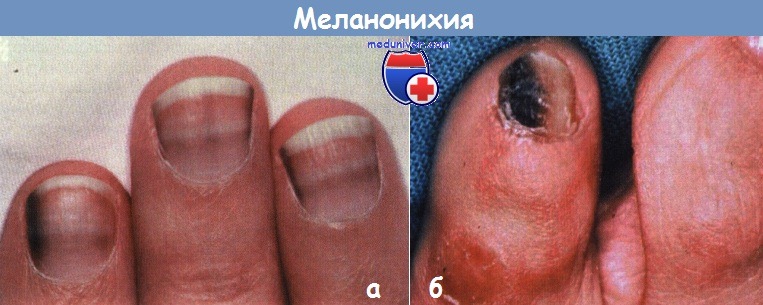 Меланонихия (коричневая полоса на ногте)