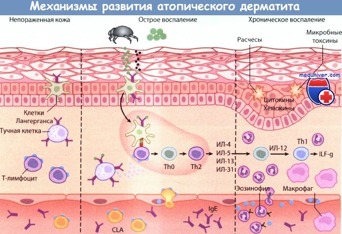 Лабораторная диагностика атопического дерматита у детей thumbnail
