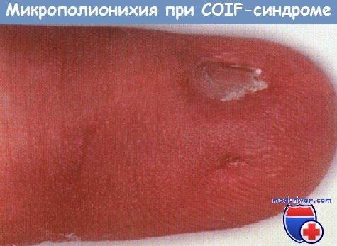 Микрополионихия при COIF-синдроме