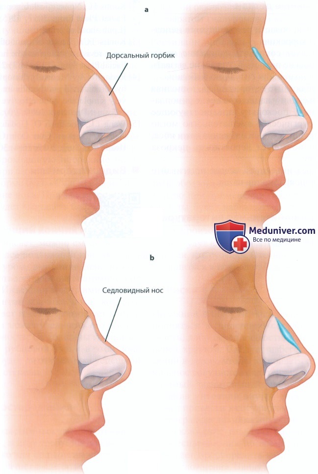 Седловидный нос - причины появления, классификация, методы коррекции