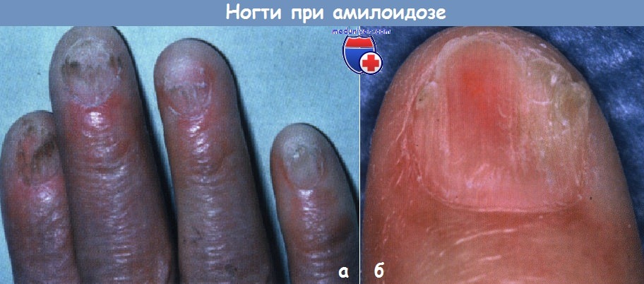 Ногти при амилоидозе