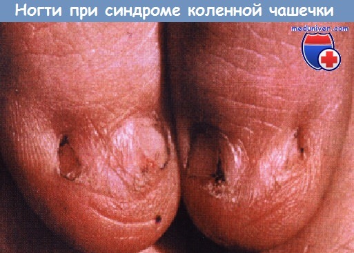 Ногти при синдроме коленной чашечки
