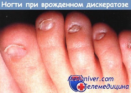 Ногти при врожденном дискератозе