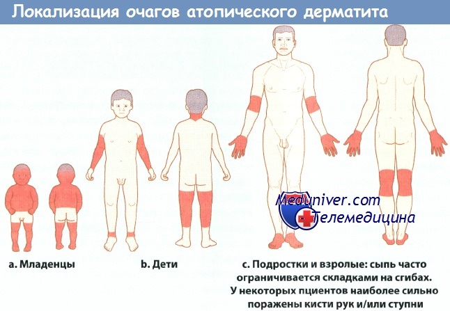 Локализация очагов атопического дерматита у ребенка
