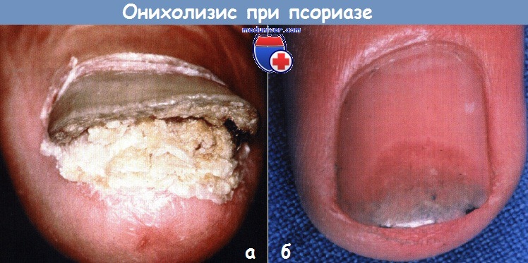 Отслоение ногтя (онихолизис) при псориазе