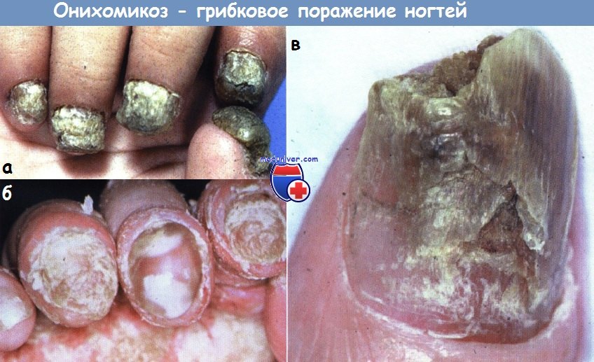 Онихомикоз - грибковое поражение ногтей