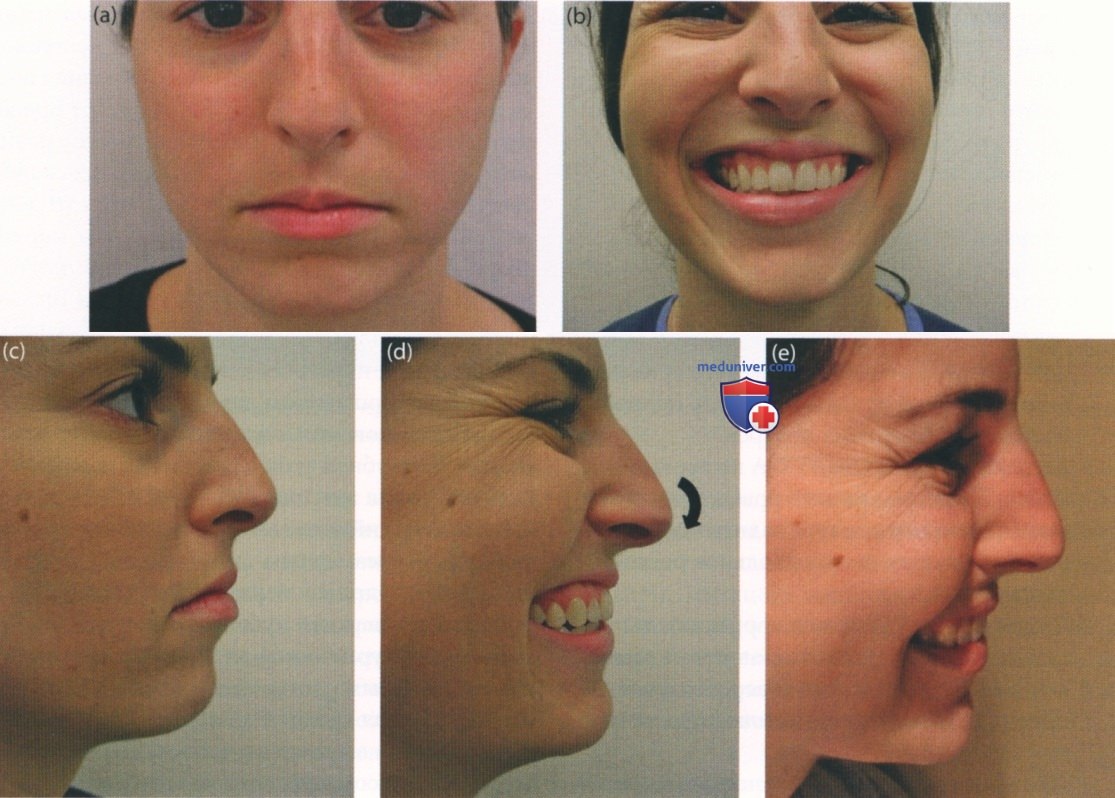 Ринопластика кончика носа: способы коррекции, противопоказания, консультация хирурга