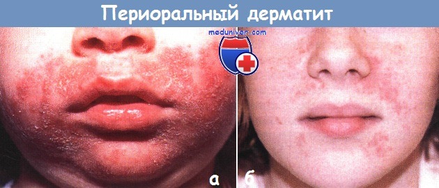 Периоральный дерматит у детей