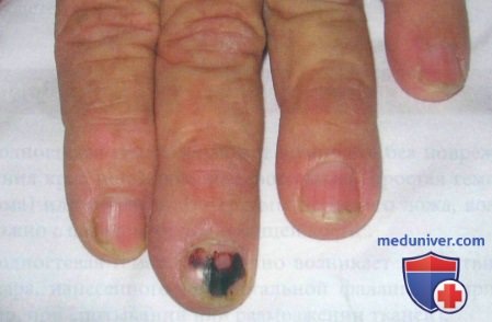 Подногтевая гематома - травма ногтя