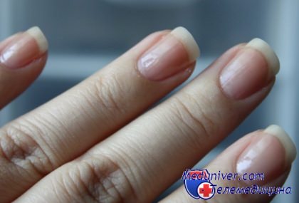 причины неровности ногтей