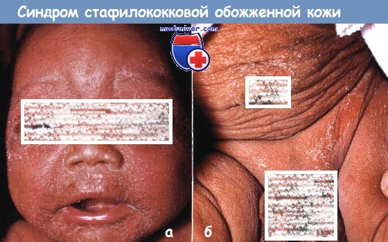 Синдром стафилококковой обожженной кожи у новорожденного