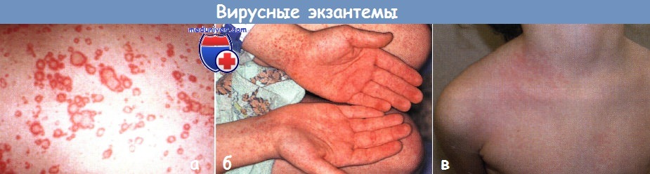 Сыпь при вирусной инфекции
