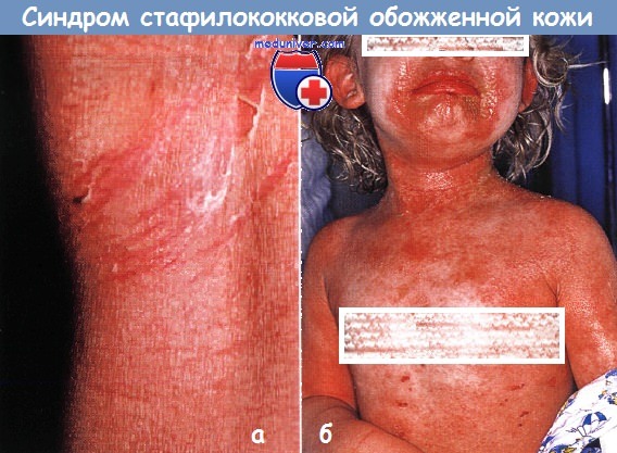 Стафилококковый синдром обожженной кожи причина thumbnail