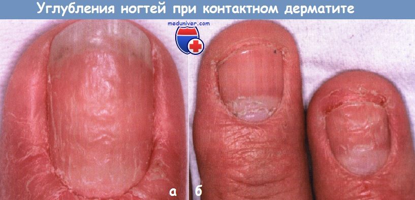 Углубления ногтей при контактном дерматите
